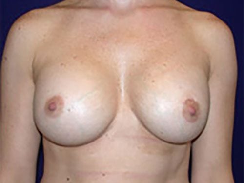 Case--2782 | After Breast Augmentation
