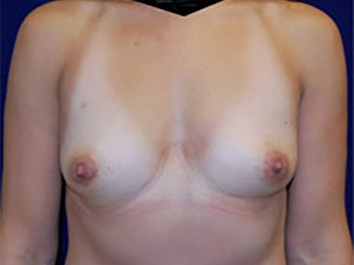 Case--4704 | Before Breast Augmentation