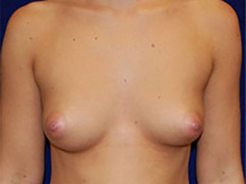 Case--6833 | Before Breast Augmentation