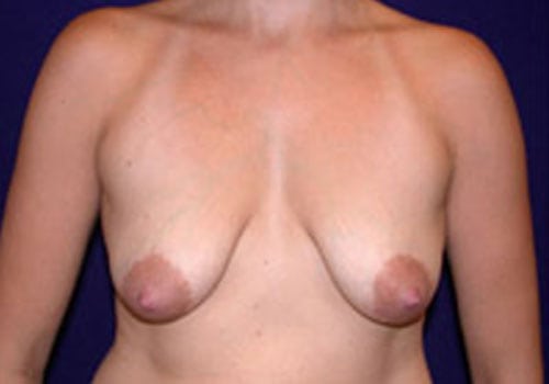 Case--8151 | Before Breast Lift