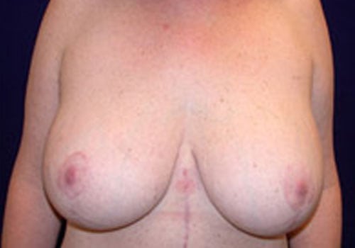Case--5179 | After Breast Lift