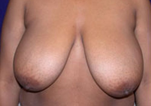 Case--7229 | Before Breast Reduction