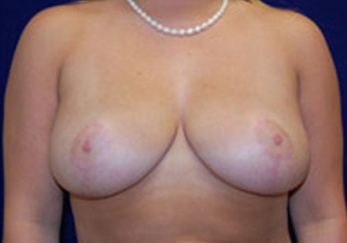 Case--3984 | After Breast Reduction