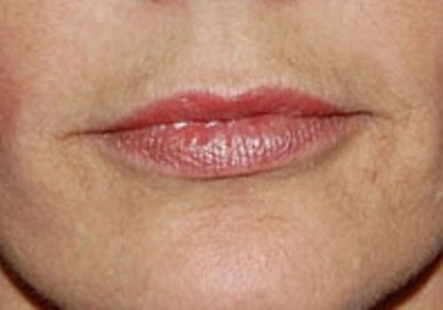 Case--3118 | Before Lip Augmentation