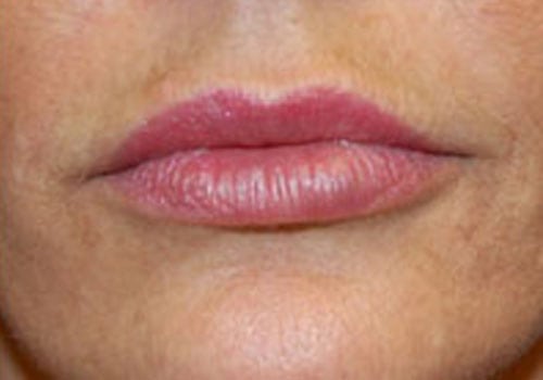 Case--3118 | After Lip Augmentation