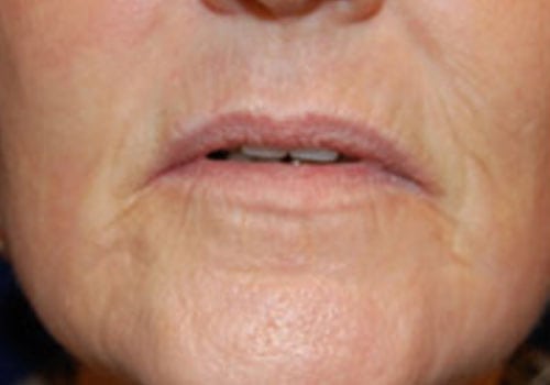 Case--7924 | Before Lip Augmentation