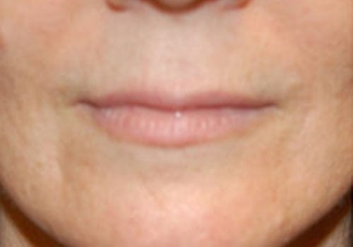 Case--8929 | Before Lip Augmentation