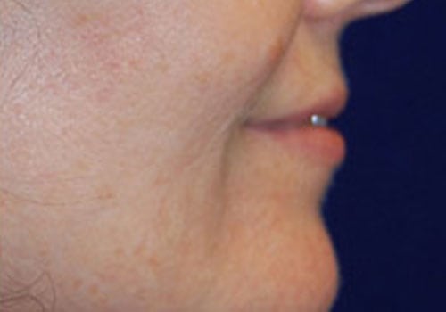 Case--8929 | After Lip Augmentation