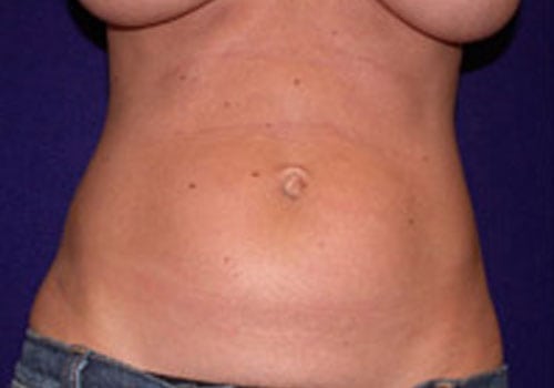 Case--4211 | Before Liposuction