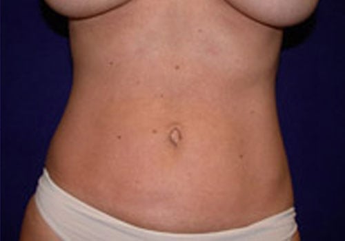 Case--4211 | After Liposuction