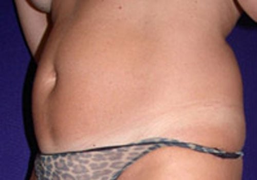 Case--8147 | Before Liposuction