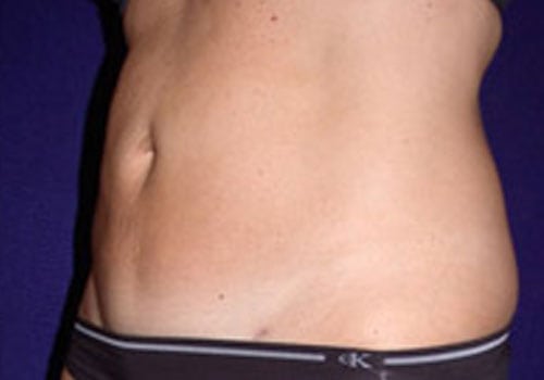 Case--8147 | After Liposuction