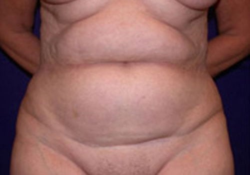 Case--6323 | Before Tummy Tuck