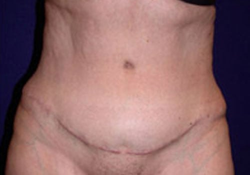 Case--6323 | After Tummy Tuck