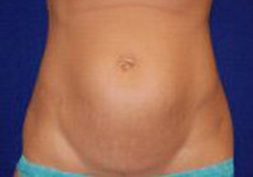 Case--6036 | Before Tummy Tuck
